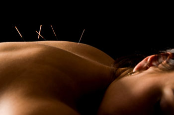 london ontario acupuncture